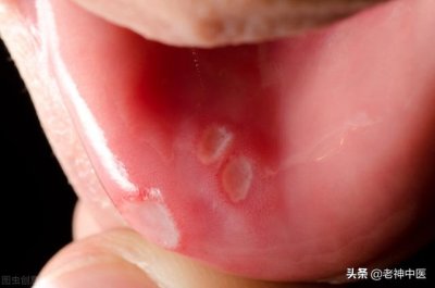 ​儿童口舌生疮治疗方法（孩子口舌生疮疼痛太难当）