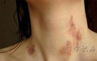 ​什么是草莓印(草莓印怎么快速消除)