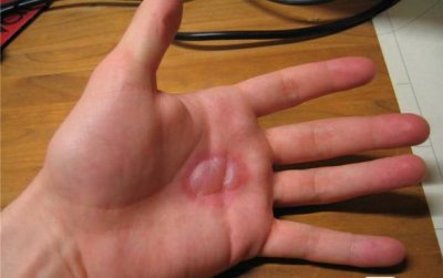 ​被热水烫伤怎么办最快最有效（被开水烫伤了怎么办？一分钟教你快速急救）