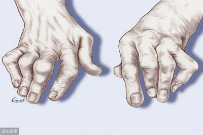 ​怎样去除痛风石 医生为你支招并提醒：预防要记住4点