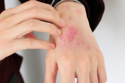 ​牛皮癣能根治吗 得了牛皮癣还可以治愈吗？