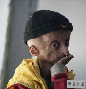 ​世界上年龄最大的早衰症患者，现已18岁仍积极乐观
