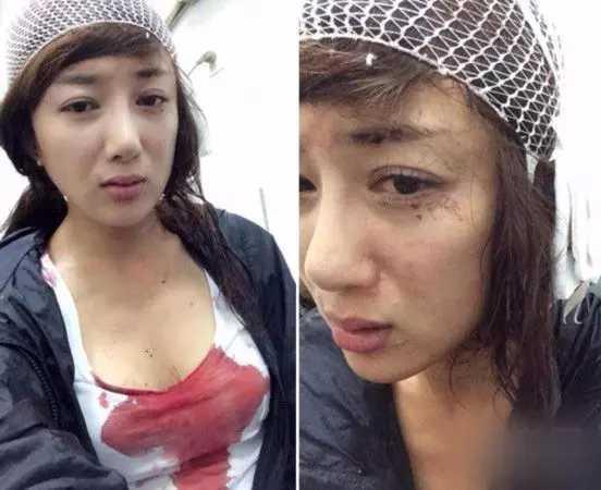 被叶璇的宠物咬了的李依晓缝了20针，整容了5次