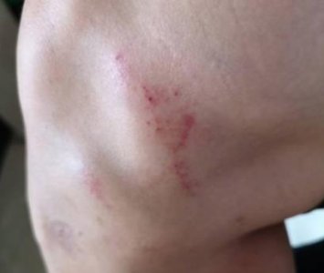 ​于大宝晒腿部伤痕后手动艾特申花：哪看出我拖时间了？