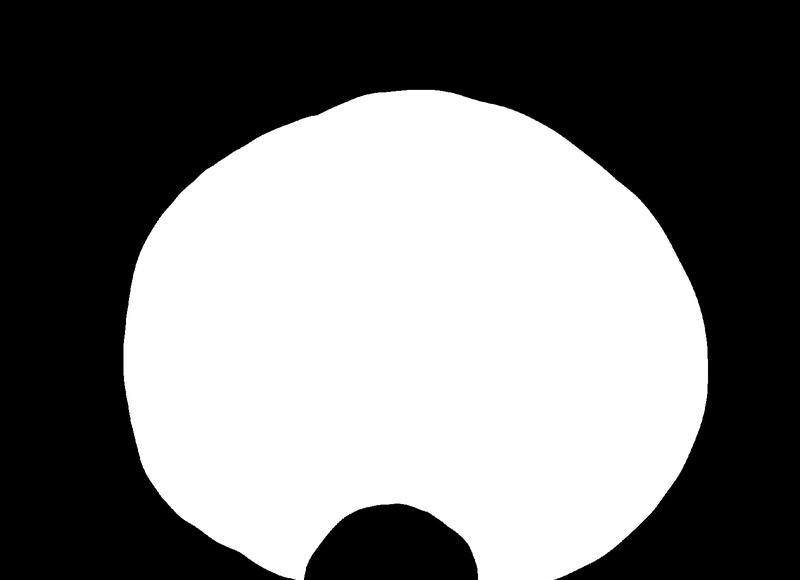 人流手术后会出现什么异样 人流手术后月经量多正常吗