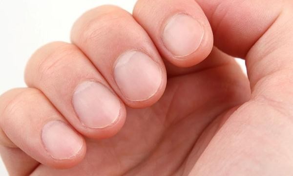 指甲竖纹怎么回事 指甲上有竖纹、长倒刺，是身体出问题了吗？