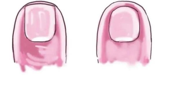 指甲竖纹怎么回事 指甲上有竖纹、长倒刺，是身体出问题了吗？