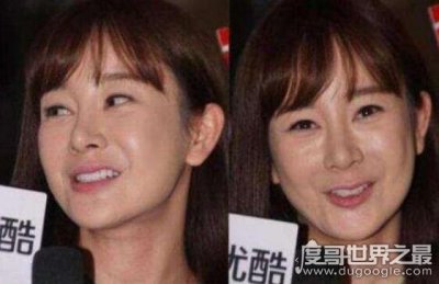 ​张檬整容失败照片曝光，面目全非整张脸已经无法动弹