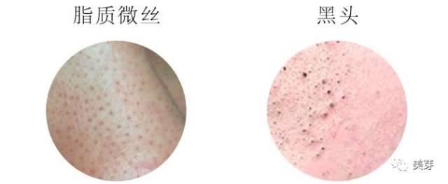 去黑头最好的方法和小妙招（去除黑头的六种方法）(6)