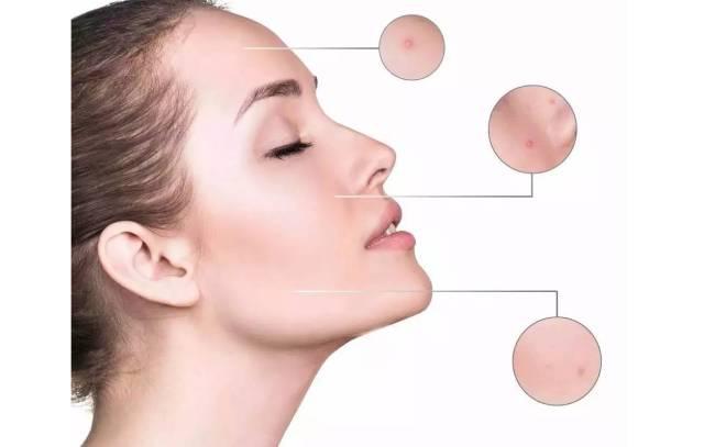 去黑头最好的方法和小妙招（去除黑头的六种方法）(21)