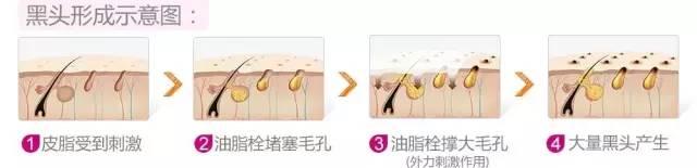 去黑头最好的方法和小妙招（去除黑头的六种方法）(8)