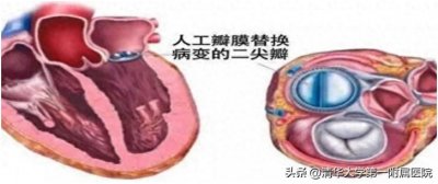 ​凝血功能中的“INR”是什么？哪些人需要定期查？