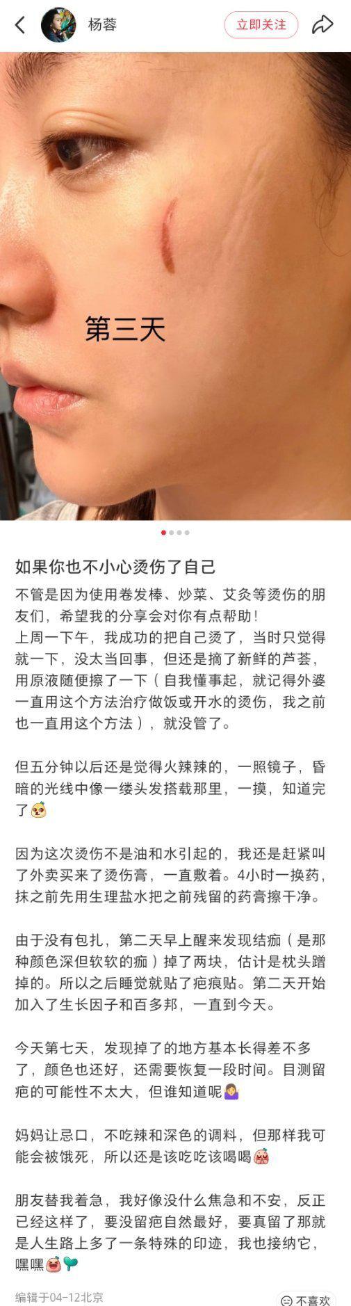 演员杨蓉晒烫伤后疤痕恢复照，称“带疤的脸很酷”