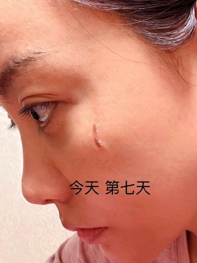 演员杨蓉晒烫伤后疤痕恢复照，称“带疤的脸很酷”