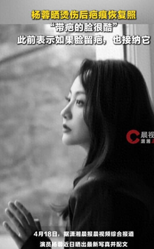 演员杨蓉晒烫伤后疤痕恢复照，称“带疤的脸很酷”