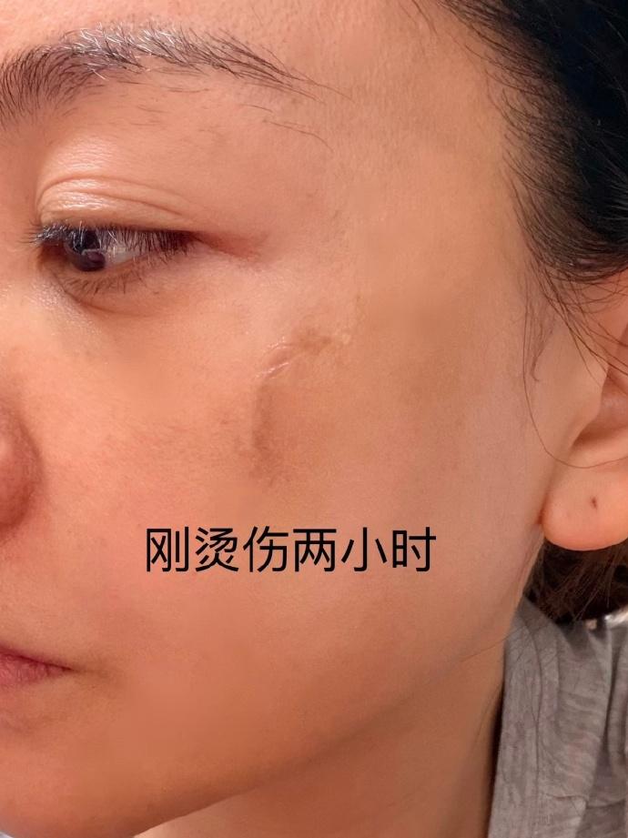 演员杨蓉晒烫伤后疤痕恢复照，称“带疤的脸很酷”